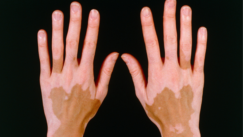 What-is-non-segmental-vitiligo-its-pathogenesis-types-diagnosis-complications-prevention-and-treatment.
