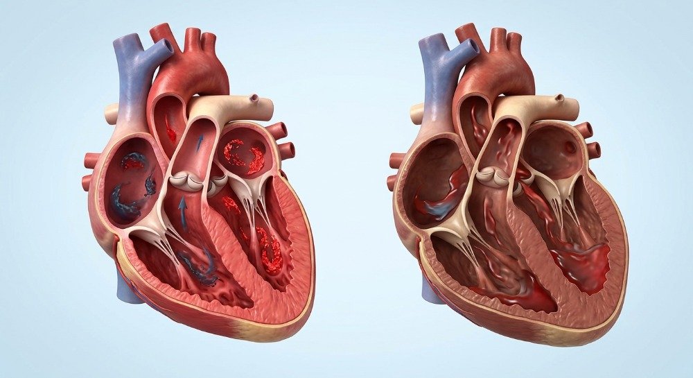 Comparison between a healthy heart and congestive heart failure