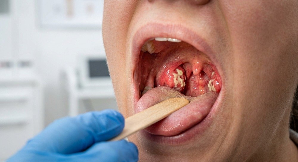Close-up of inflamed tonsils with white spots during a medical throat examination.